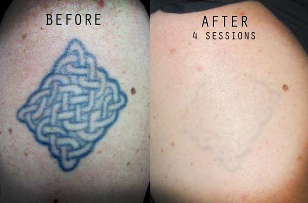 Laser Tattoo Removal in Delhi – DermaWorld Skin Clinic